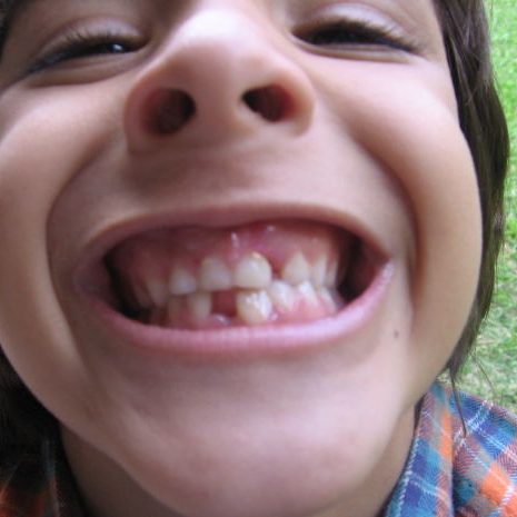 permanent teeth coming in baby teeth falling out