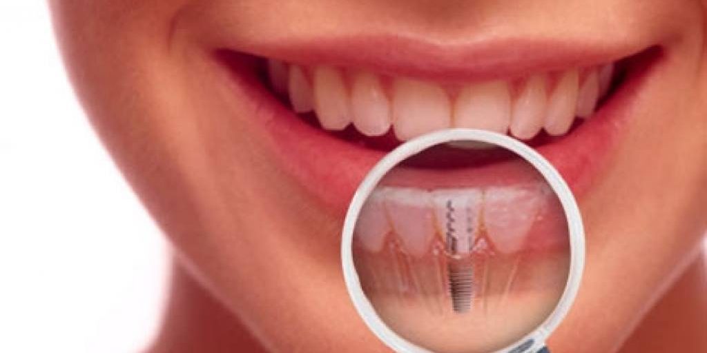 Bellevue Dental Implants - Bellevue Dentistry