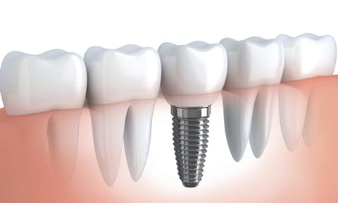 Dental Implants by Smiles of Bellevue