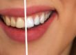 tooth whitening aftercare with your bellevue dentist