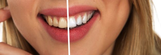 tooth whitening tooth whitening aftercare with your bellevue dentist